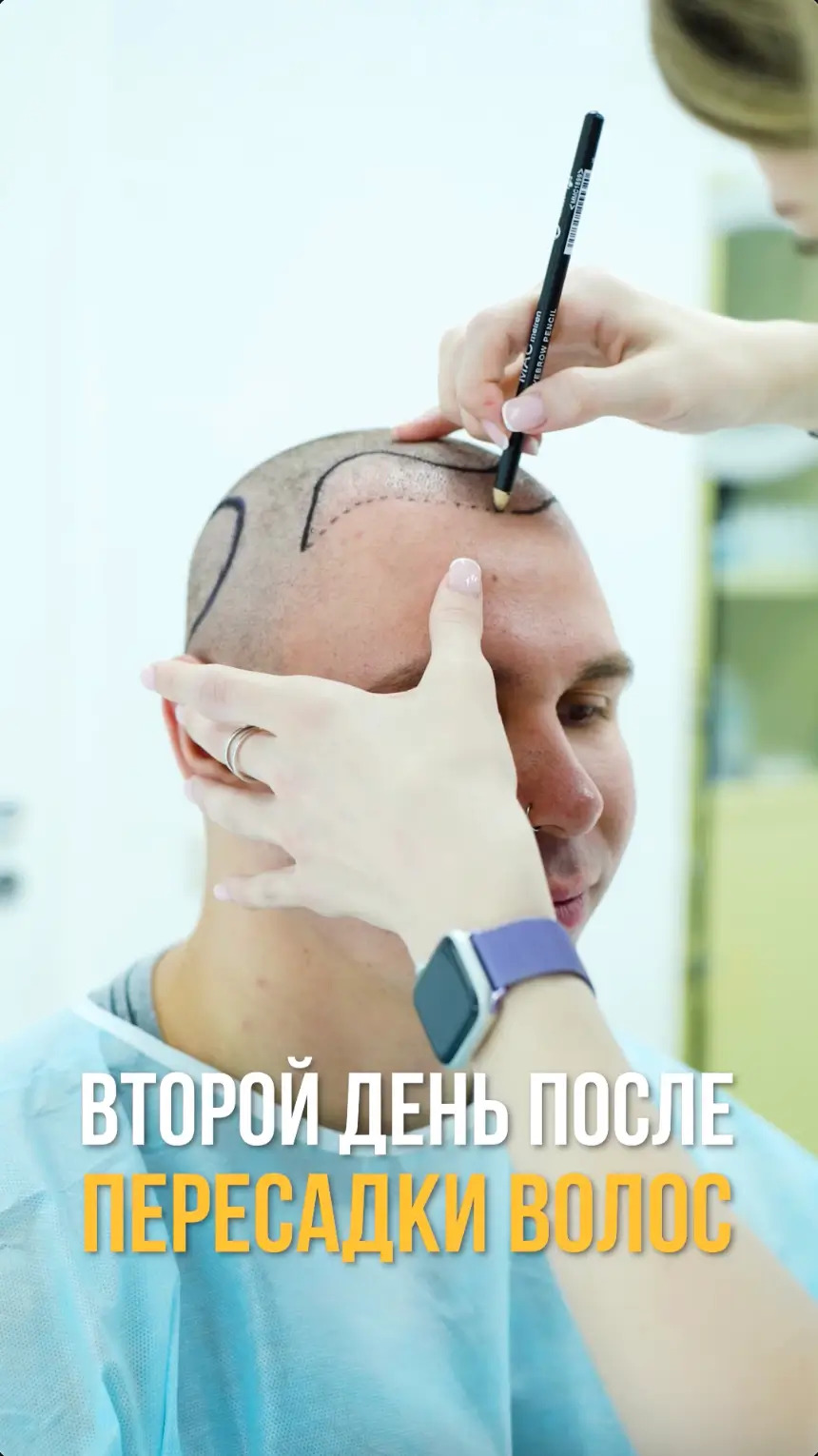 Ролик клиники ГМЦ о пересадке волос