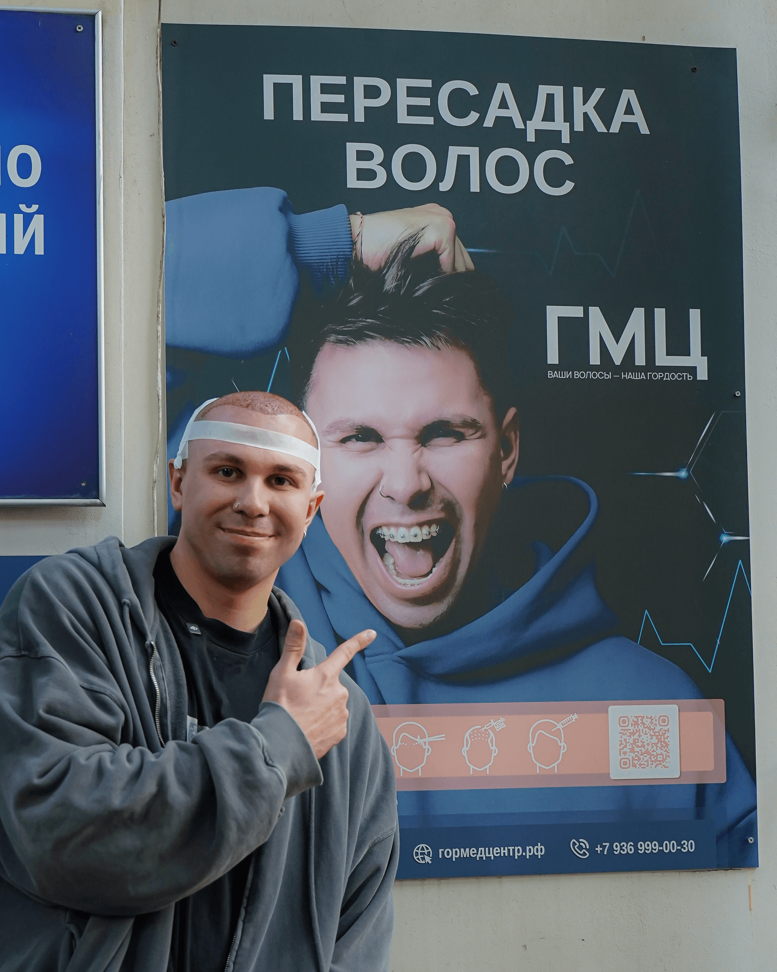 Пересадка волос СПБ