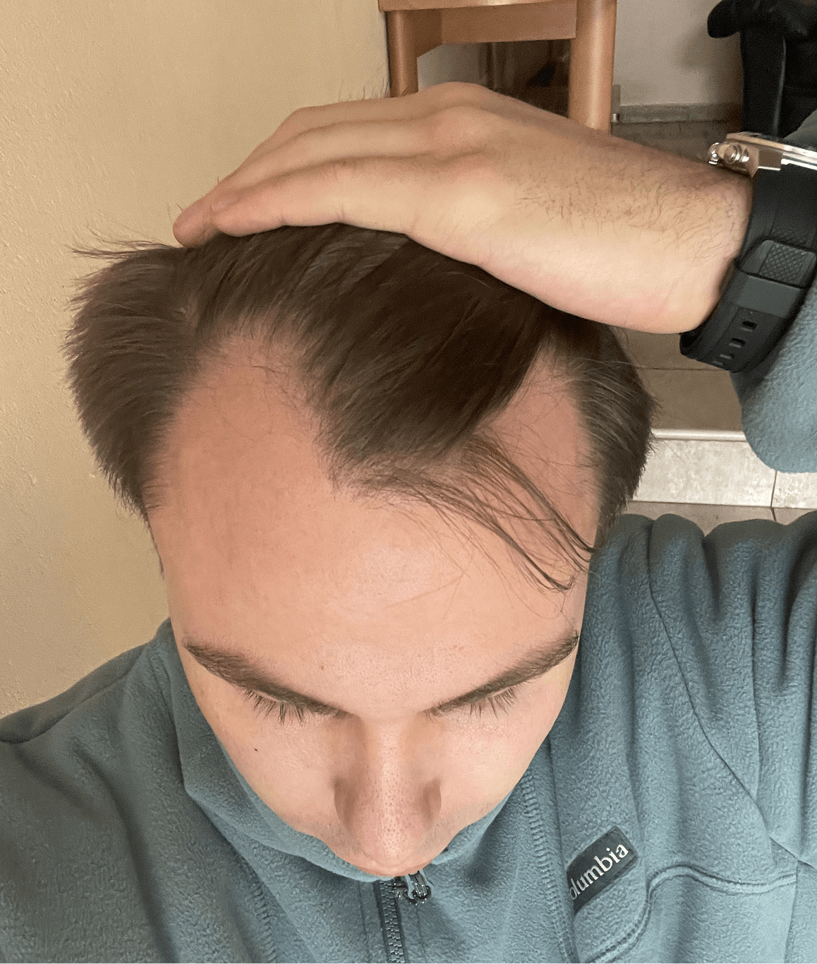 Пересадка волос в Санкт-Петербурге