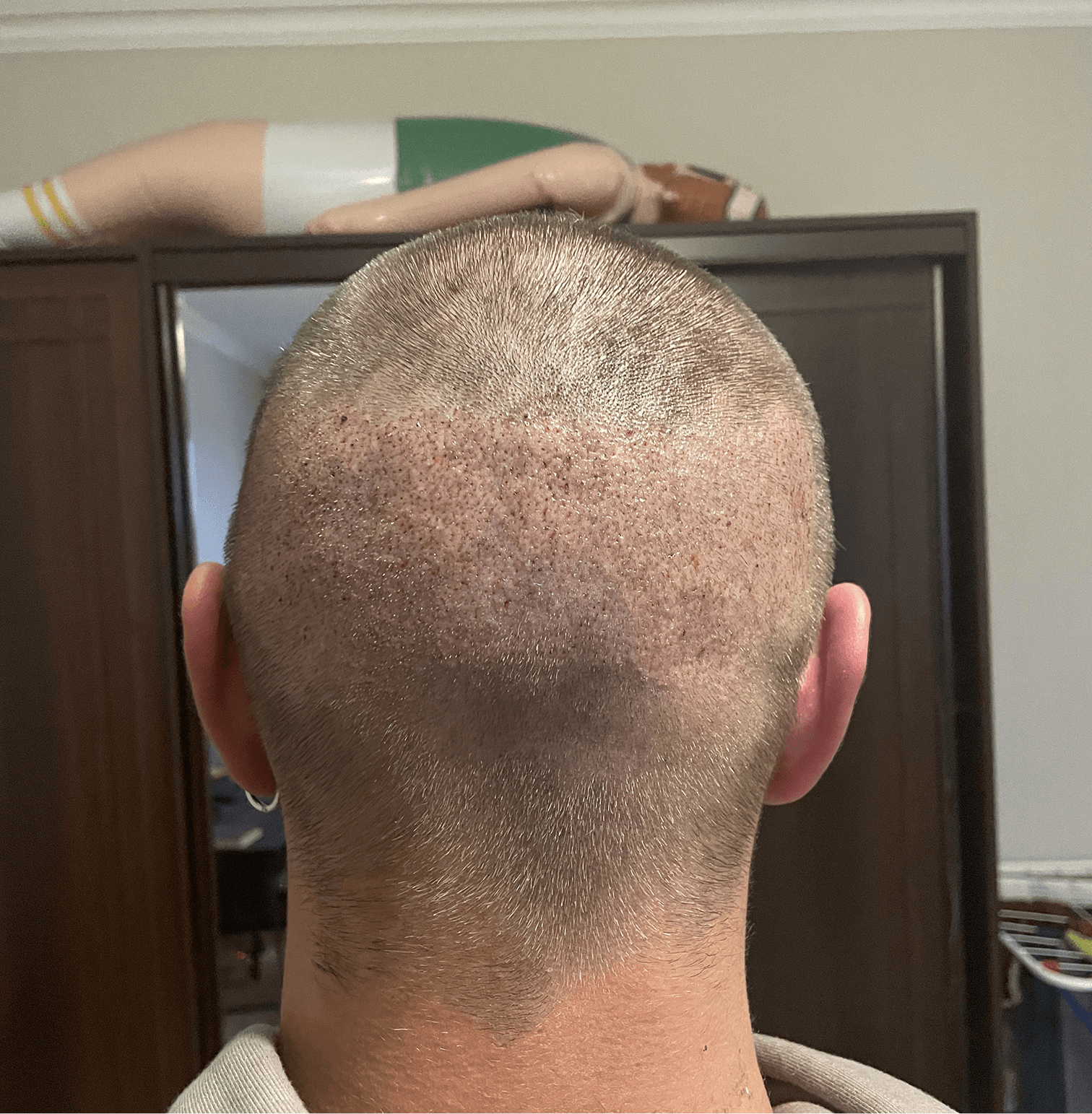 Пересадка волос СПБ цена — как формируется стоимость, где сэкономить и на что обратить внимание